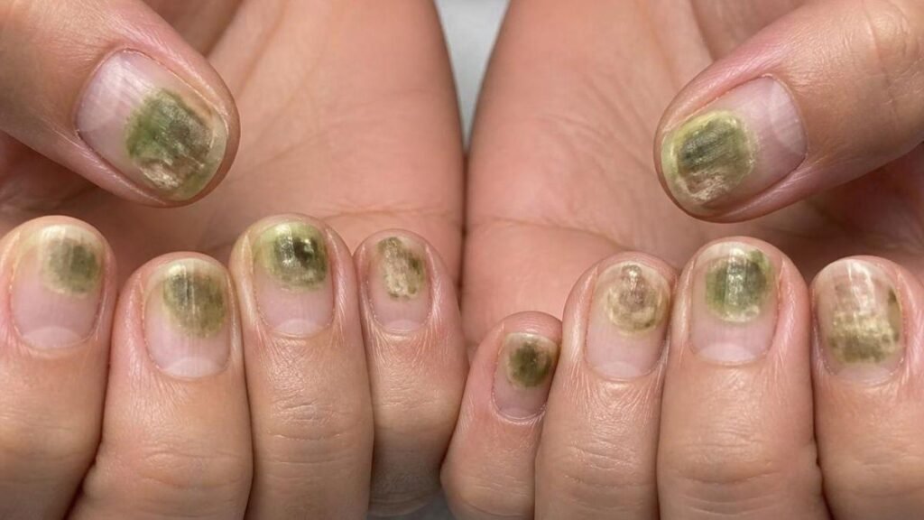 Uñas verdes por acrílico: causas y soluciones efectivas